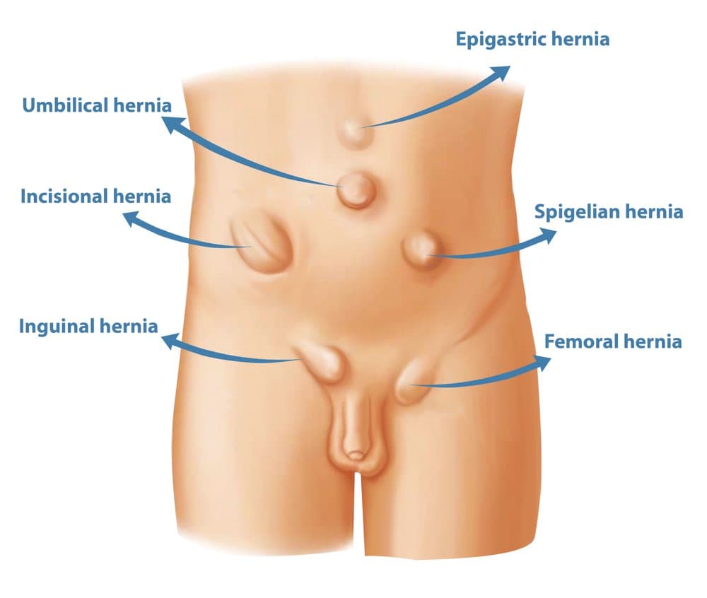 Inguinal Hernia Illustration