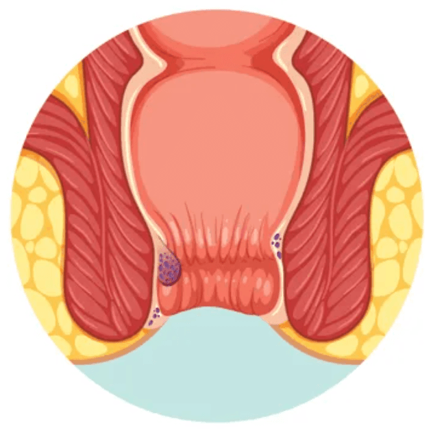 Grade I Piles illustration