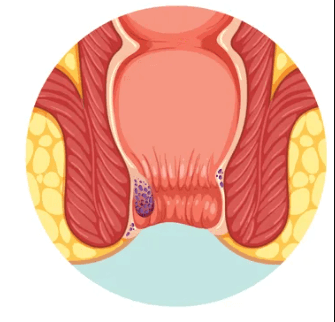 Grade II Piles illustration