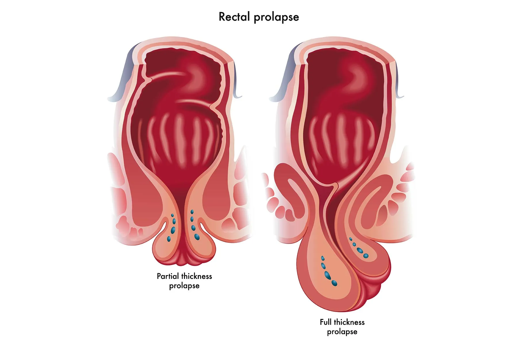 Pelvic Prolapse Overview