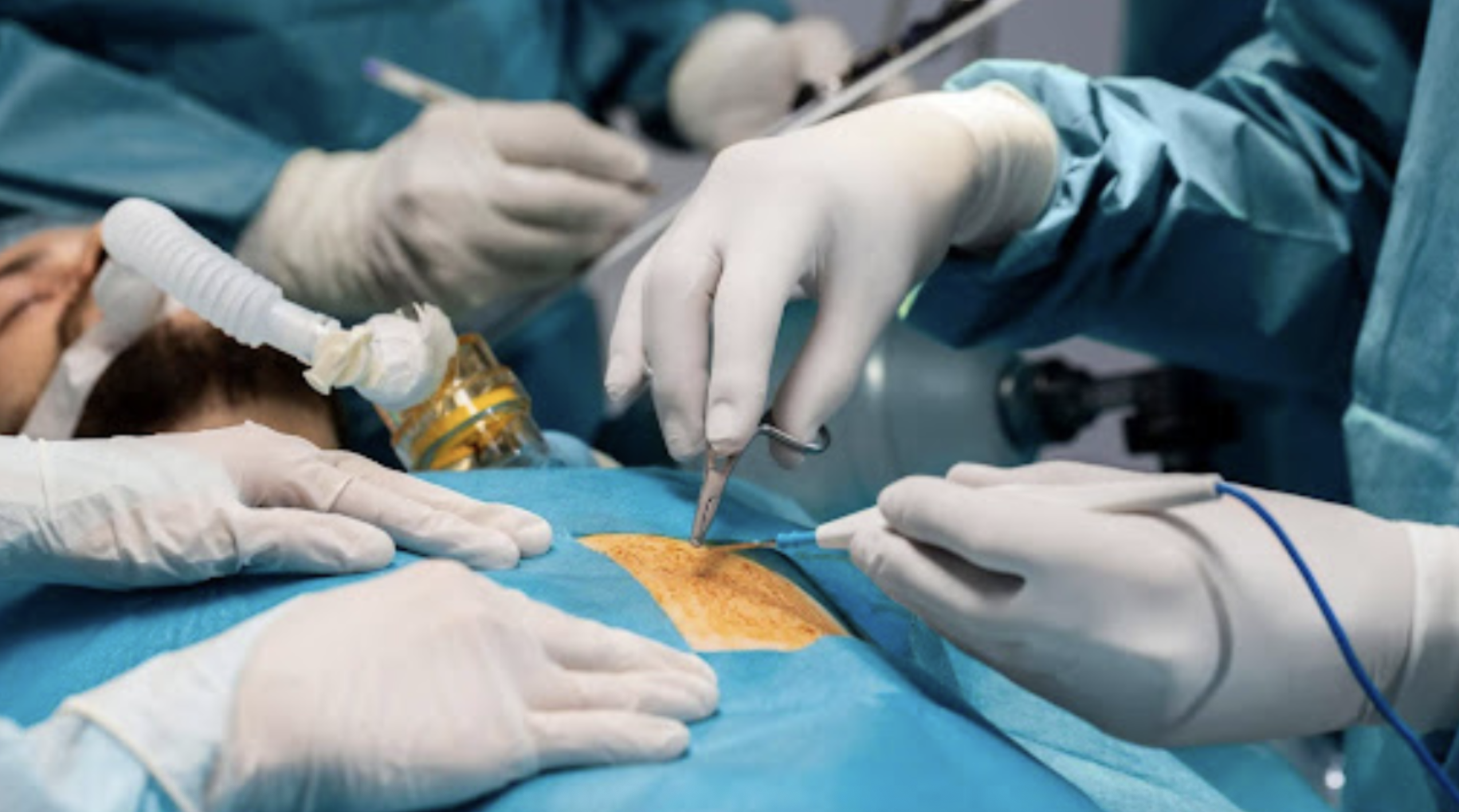 Laparoscopic Hernia Repair - Laparoscopic surgery by Dr. Jaya Maheshwari