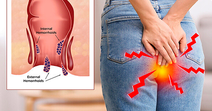 Fistula: Anal Fistula